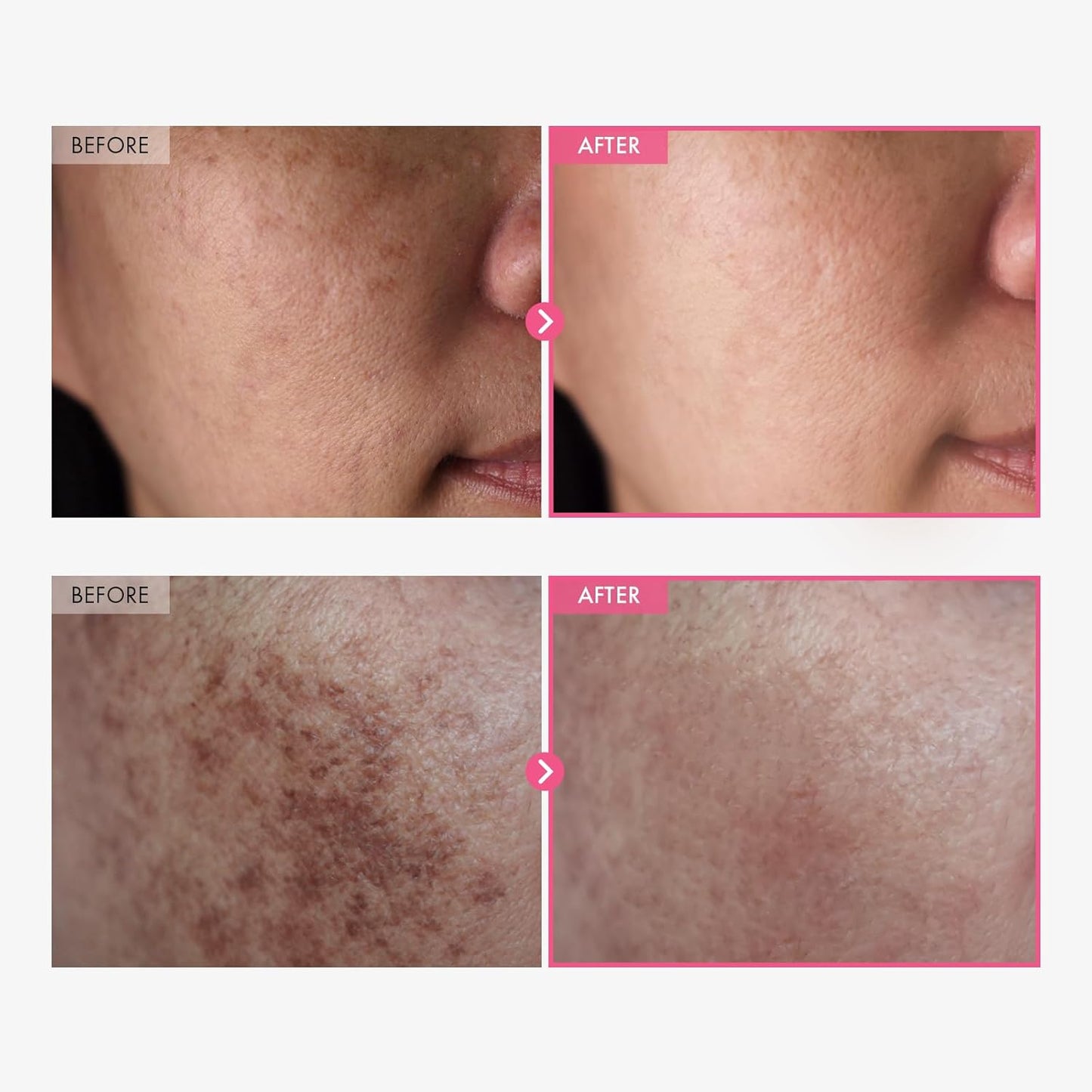 Carvenchy | Arbutin 7% + Tranexamic Acid 4% Cream