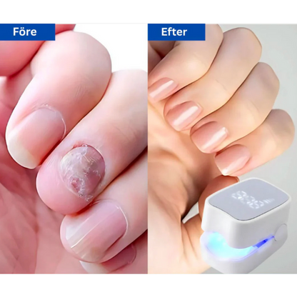 ReviNail™ – Fri från nagelsvamp. Fri att vara du.